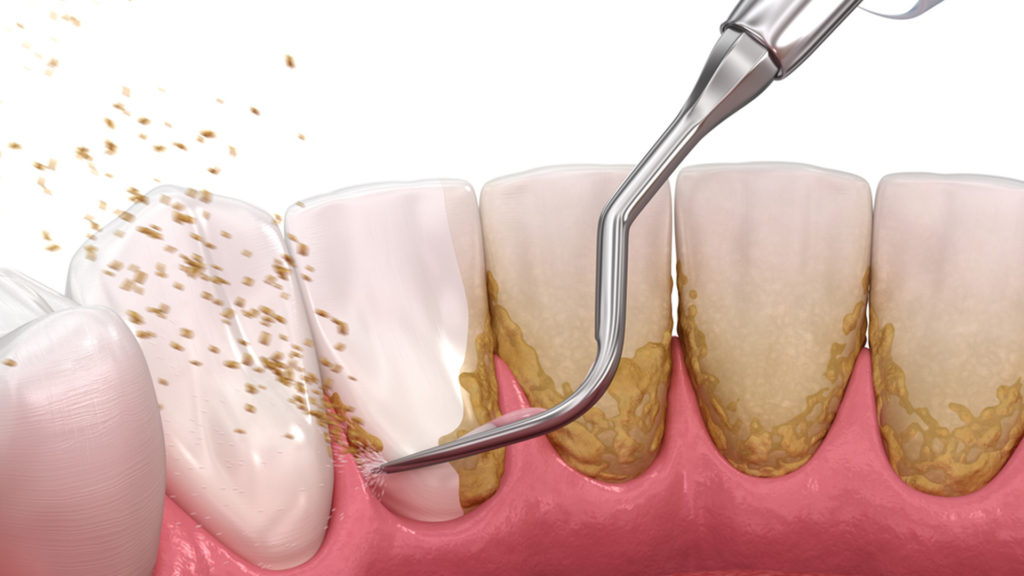 Periodontal-gun-disease-therapy - Bayshore Dental